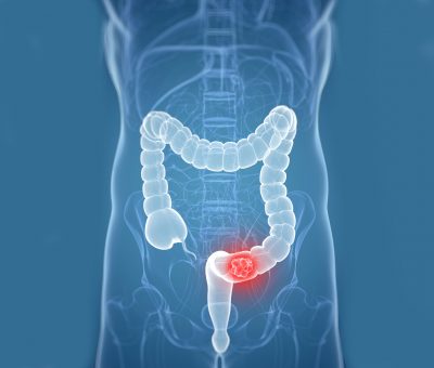 A new automated system to detect colorectal cancer