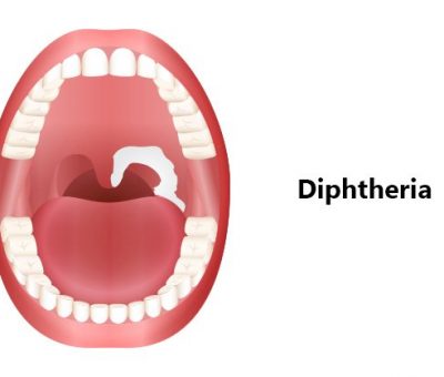 Study warns Diphtheria could become a major global threat