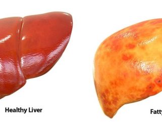 Researchers reveal how excess sugar causes fatty liver
