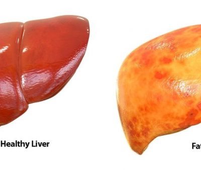 Researchers reveal how excess sugar causes fatty liver